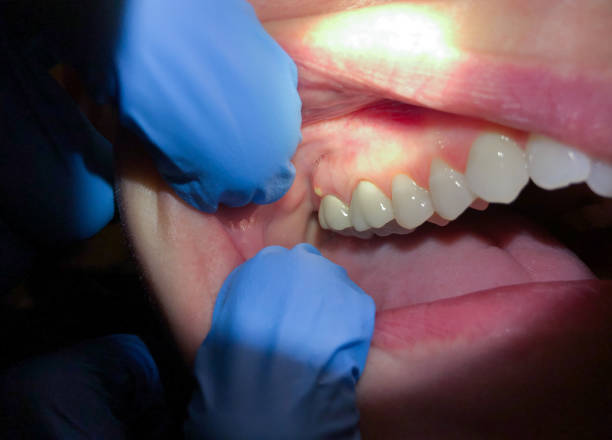 Best Emergency Tooth Extraction in Pennsboro, WV